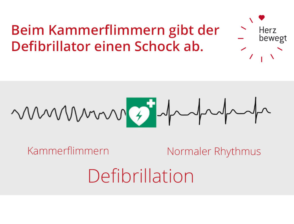 10 Antworten zum Thema Defibrillator Herz bewegt 10 Antworten zum Thema Defibrillator Herz bewegt